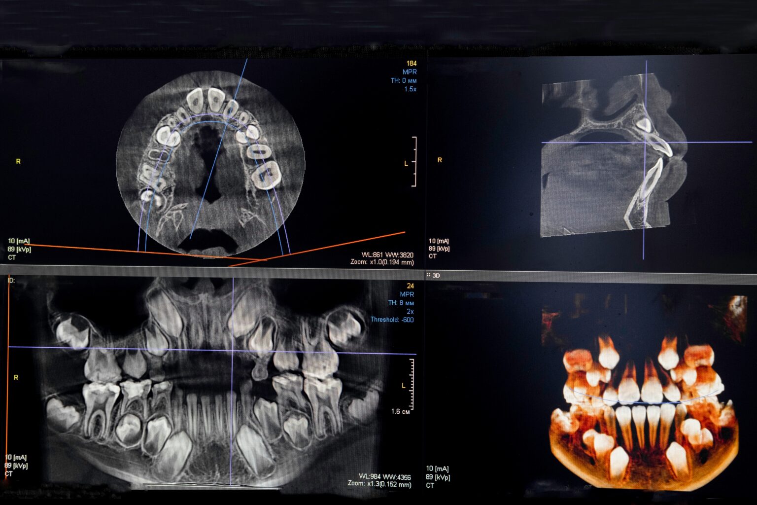 CBCT 3D Imaging for Accurate Diagnosis
